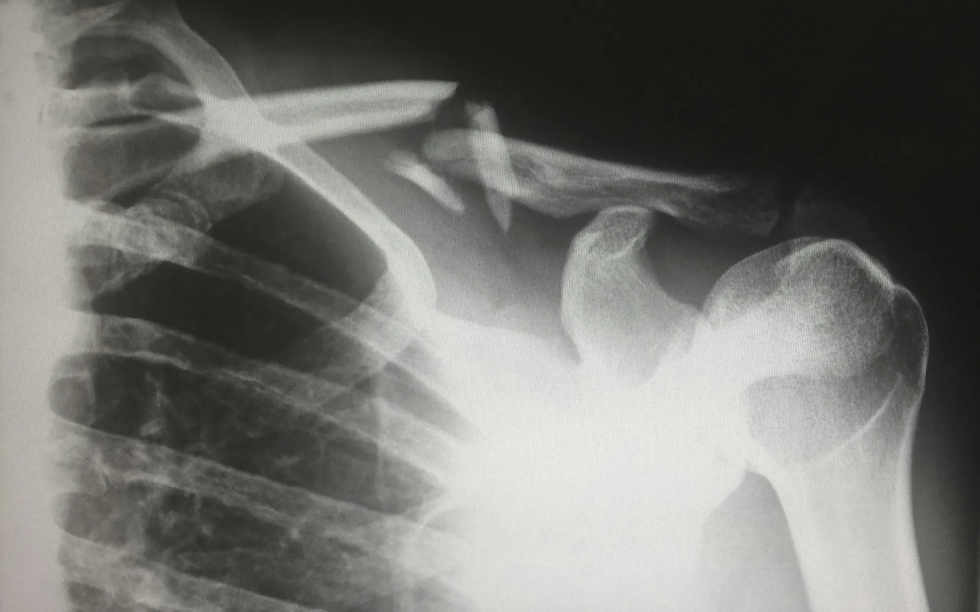 Understanding Pennsylvania's Wrongful Death Claims for Catastrophic Injuries