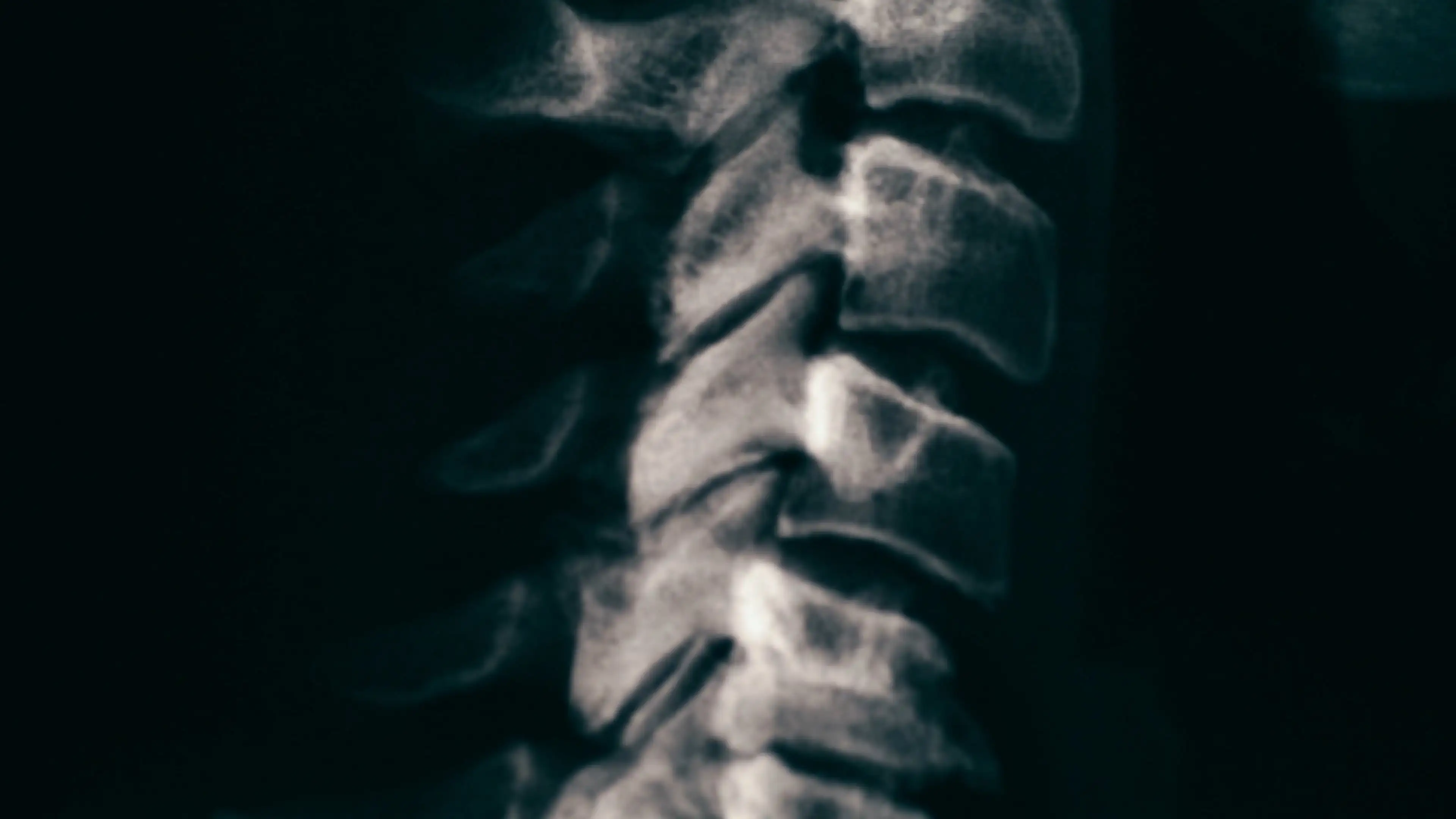 Philadelphia Spinal Cord Injuries Lawyer