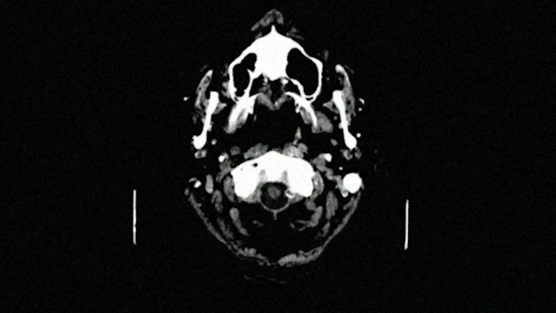 Philadelphia Traumatic Brain Injuries Lawyer