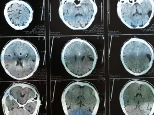 Proving Cognitive Impairment in TBI Cases Without MRI Evidence