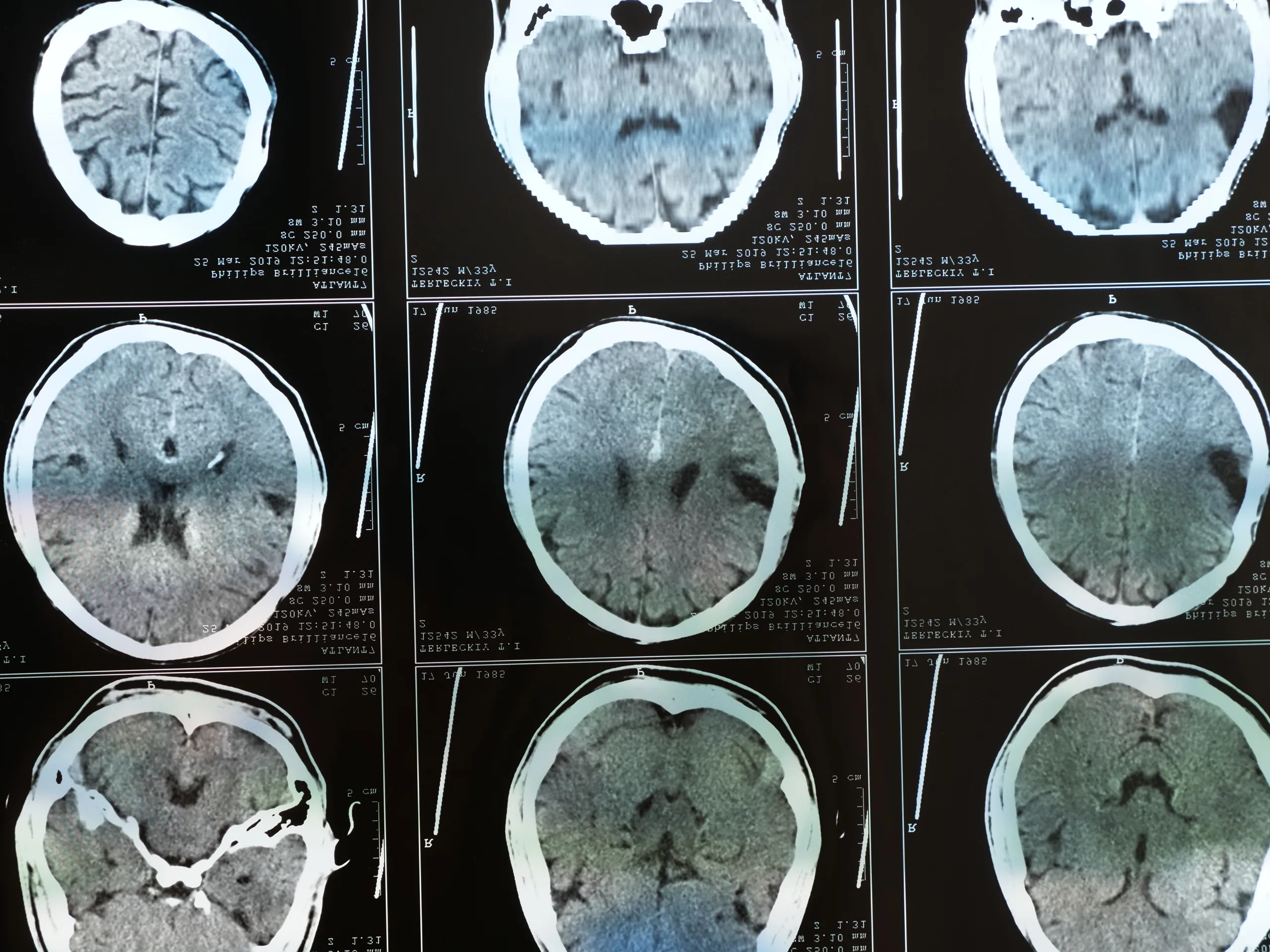 Proving Cognitive Impairment in TBI Cases Without MRI Evidence