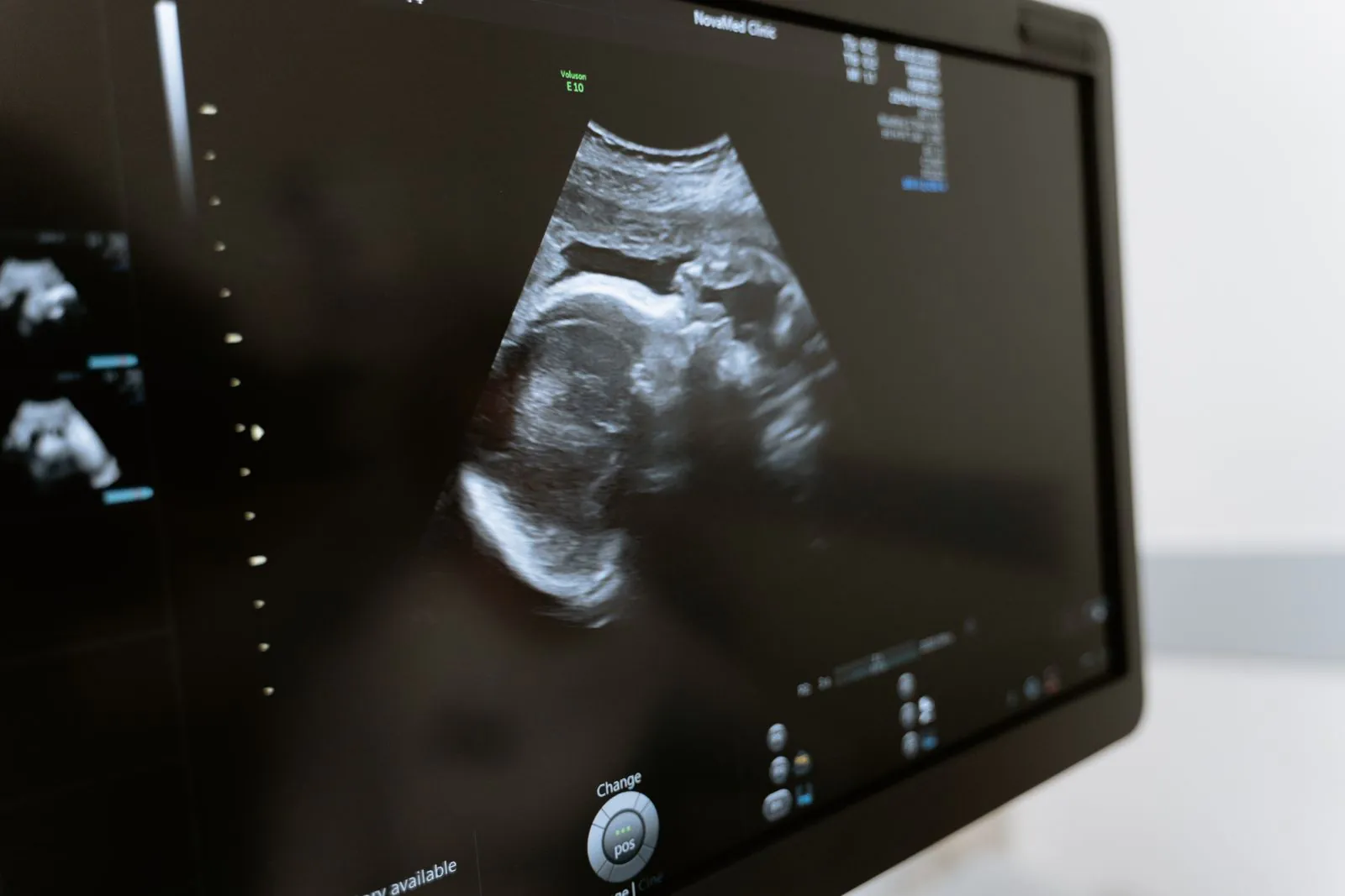 Ultrasound image of a fetus on a monitor during a prenatal scan
